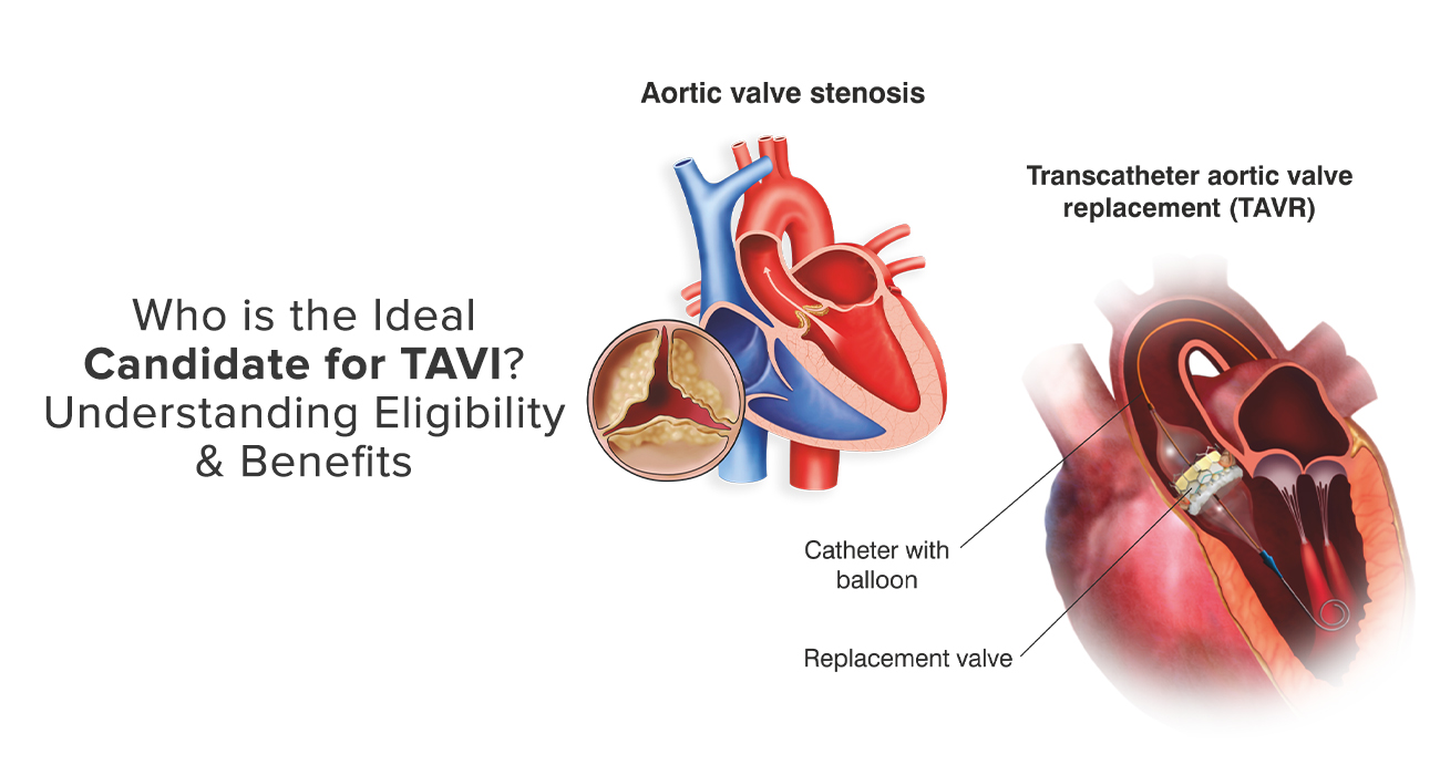 Who Is The Ideal Candidate For TAVI? Understanding Eligibility & Benefits